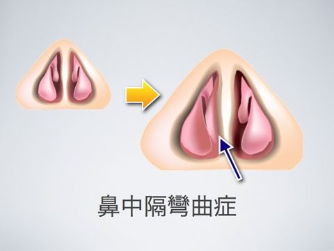 鼻中隔湾曲症