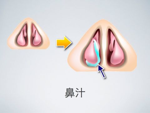 鼻汁